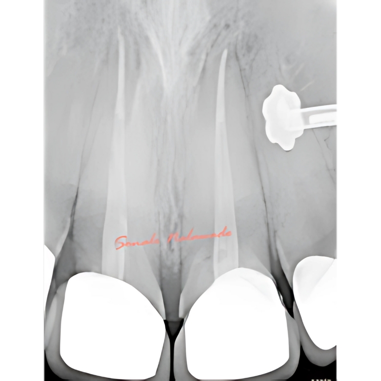 Root Canal Cleaning in Ravet – Gentle Infection Removal